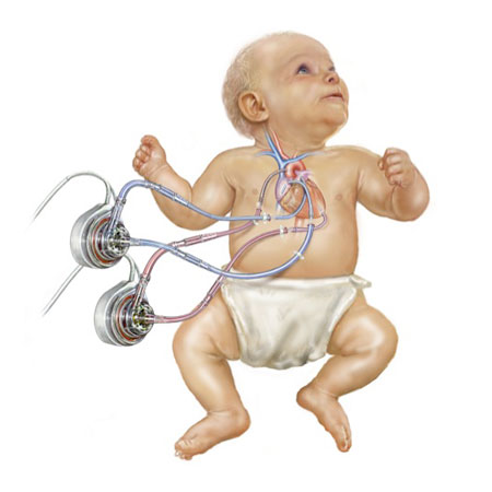 Pediatric Heart Pumps